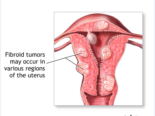 Discover Relief with Our Fibroid Natural Eradication Therapy Pack